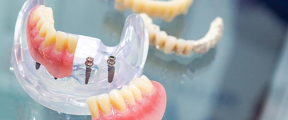 前歯のインプラント治療との違い