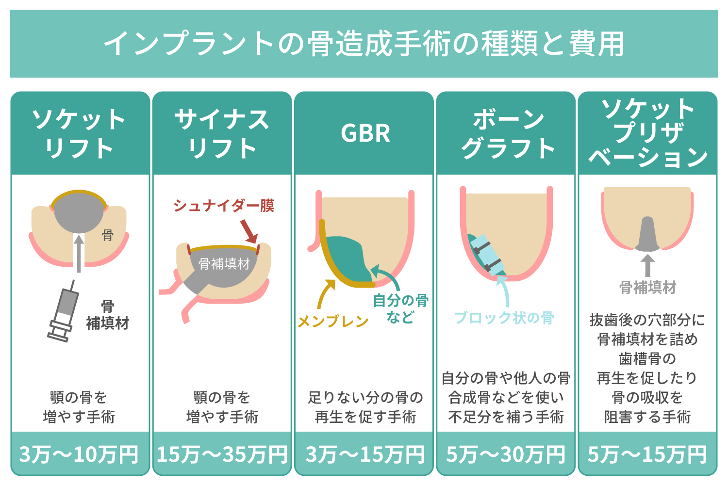 インプラントの骨造成手術の種類と費用