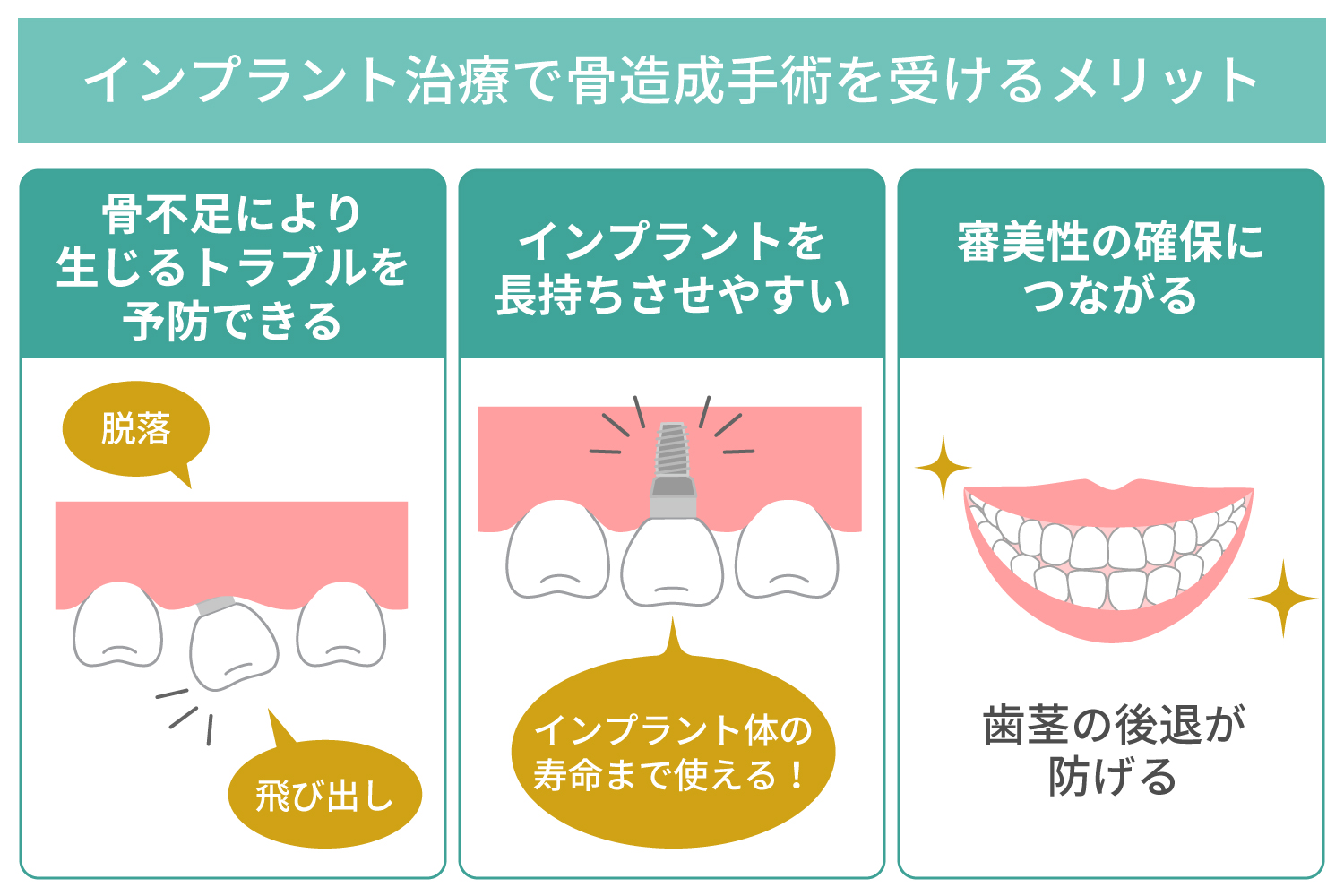 インプラント治療で骨造成手術を受けるメリット