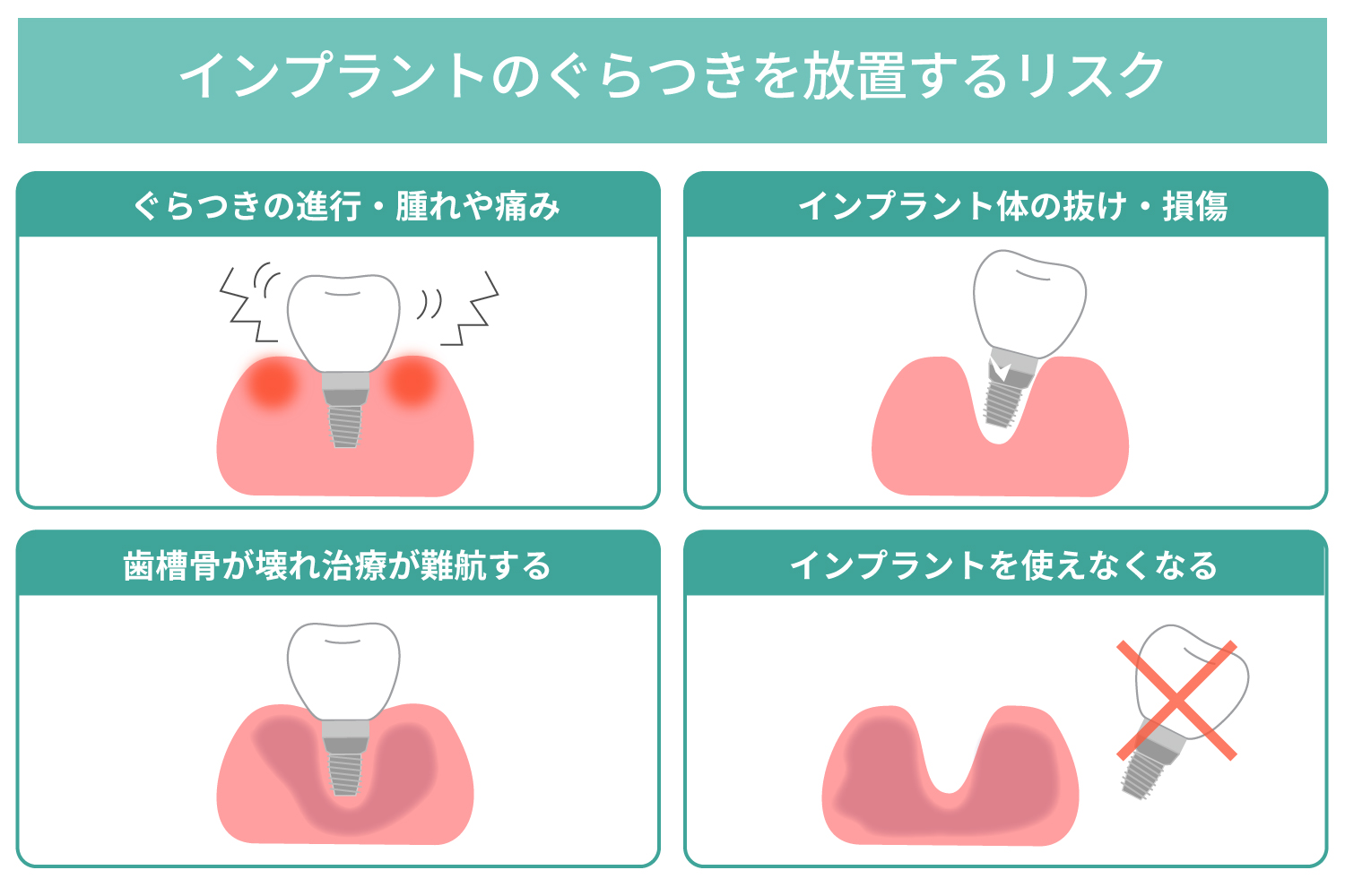インプラントのぐらつきを放置するリスク