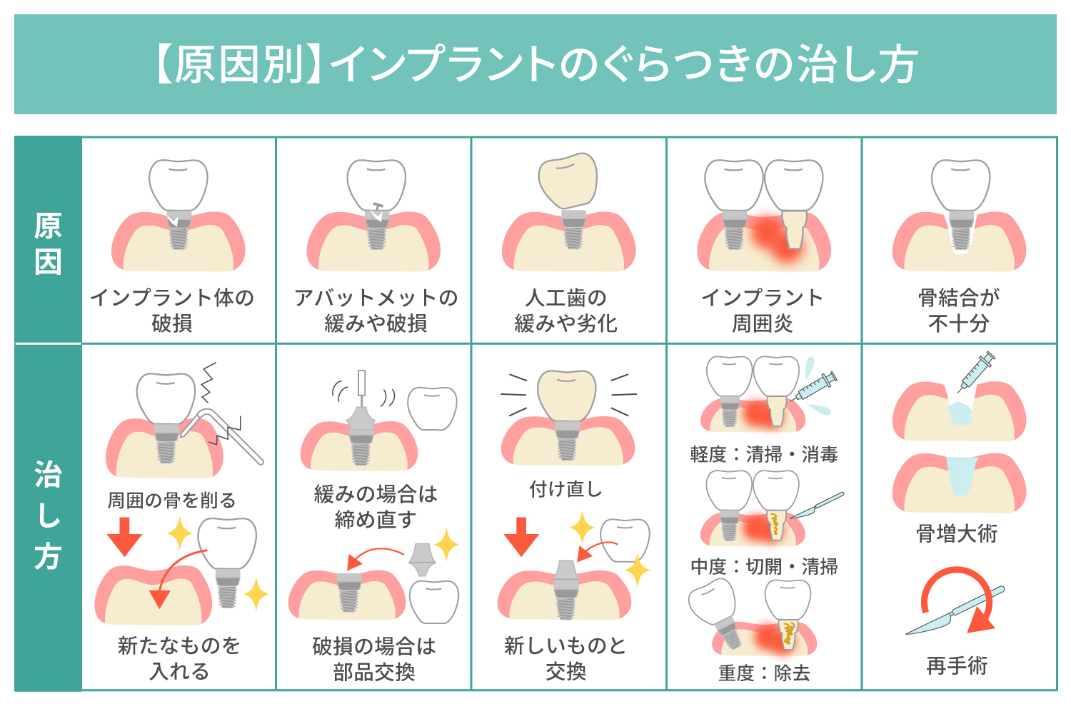 【原因別】インプラントのぐらつきの治し方