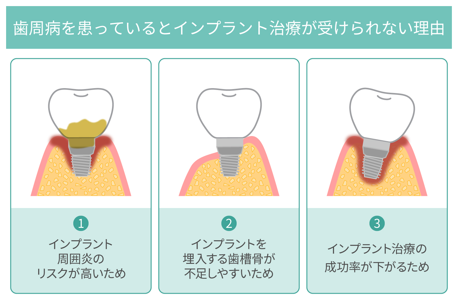 歯周病を患っているとインプラント治療は受けられない
