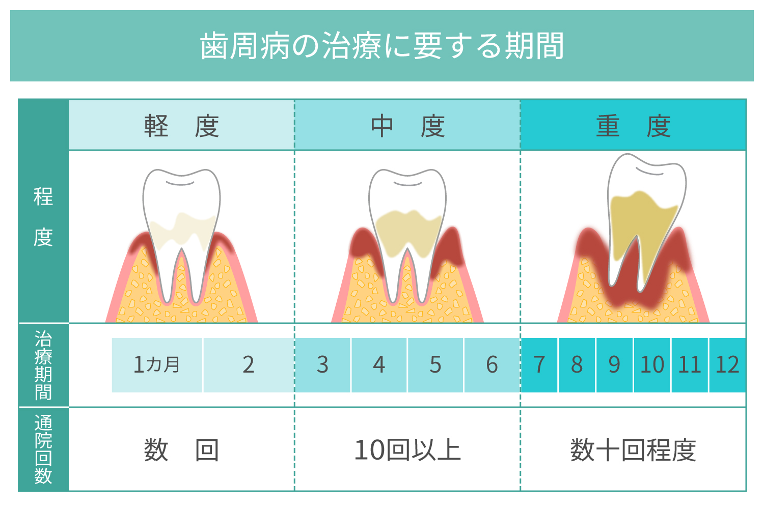 歯周病治療にかかる期間