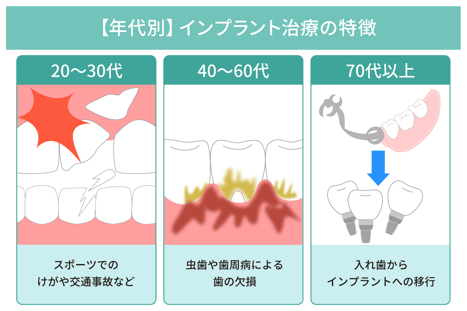 【年代別】インプラント治療の特徴？