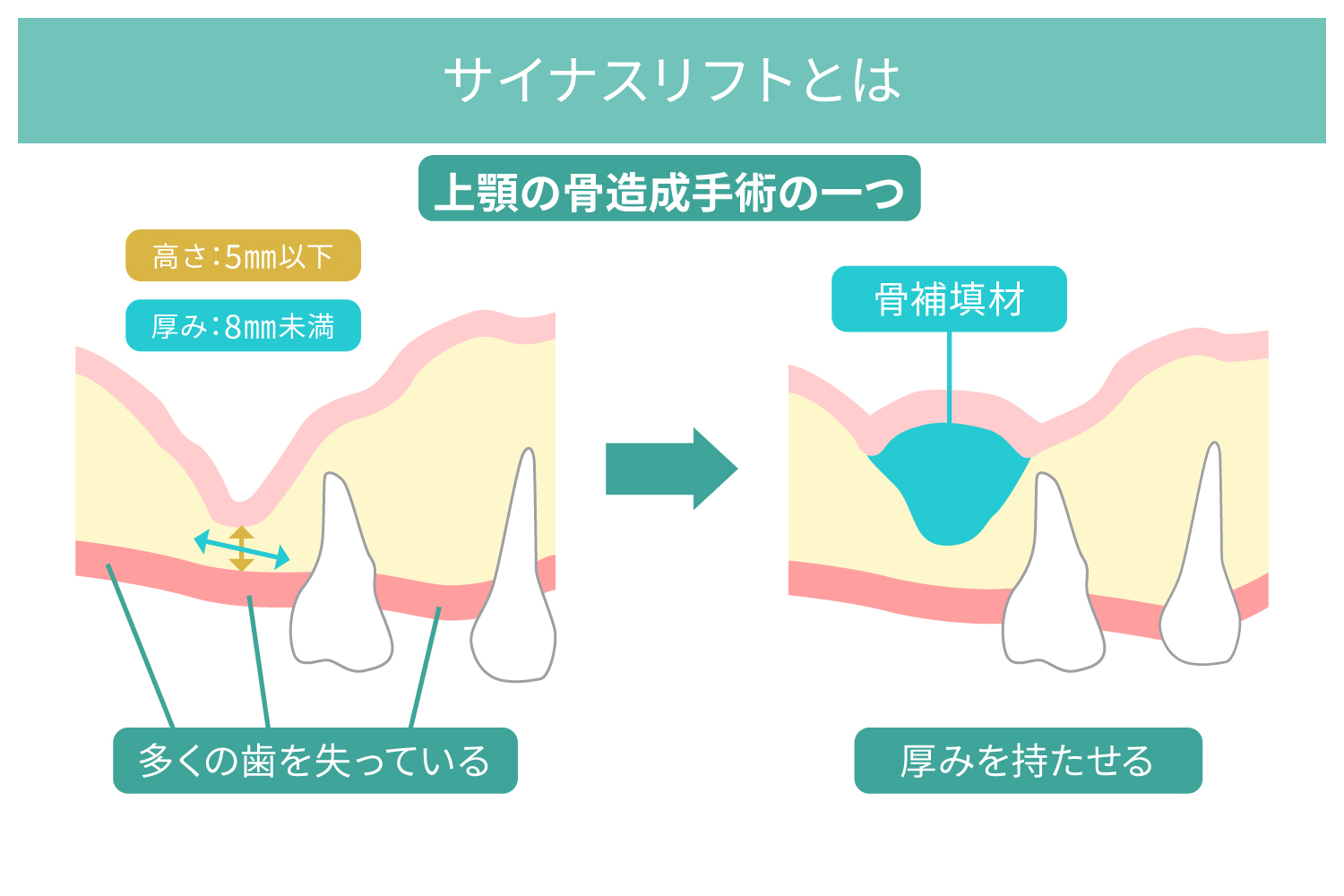 サイナスリフトとは上顎の骨造成手術のこと