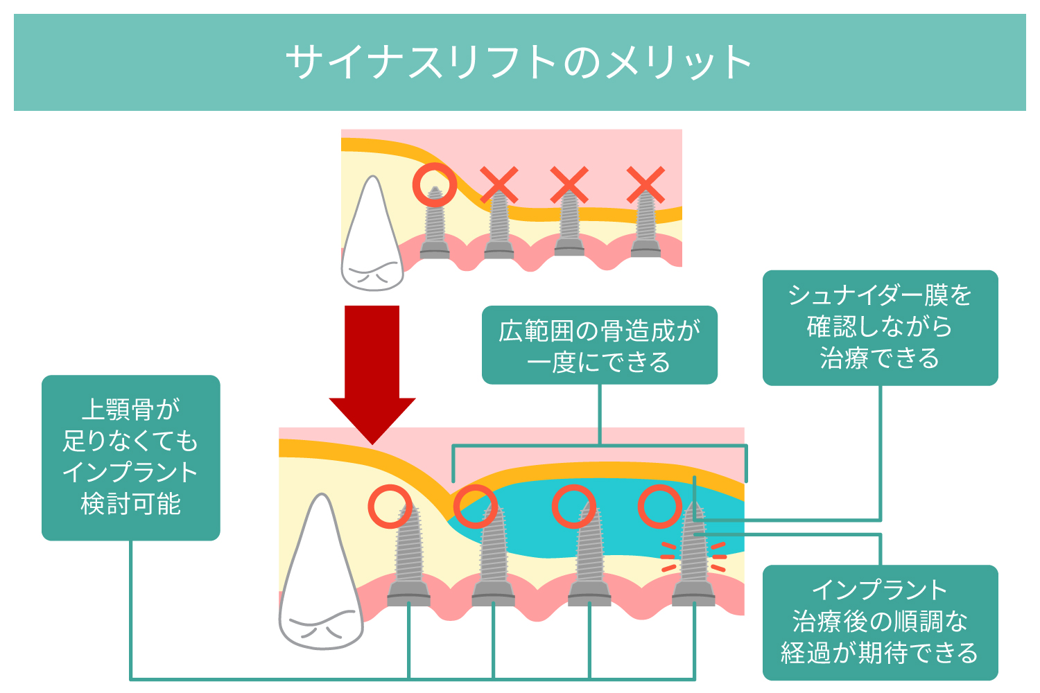 サイナスリフトのメリット