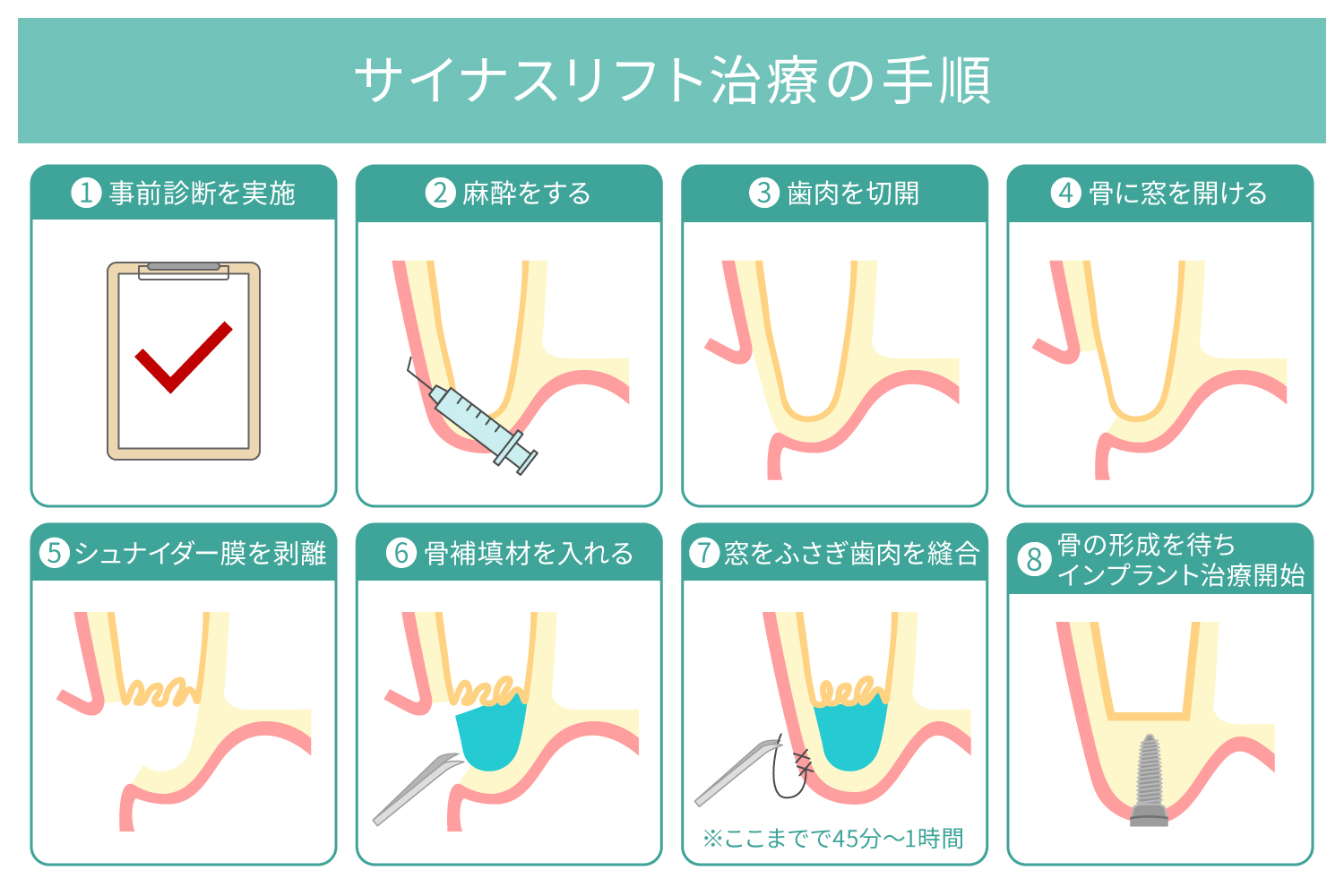 サイナスリフトの手順