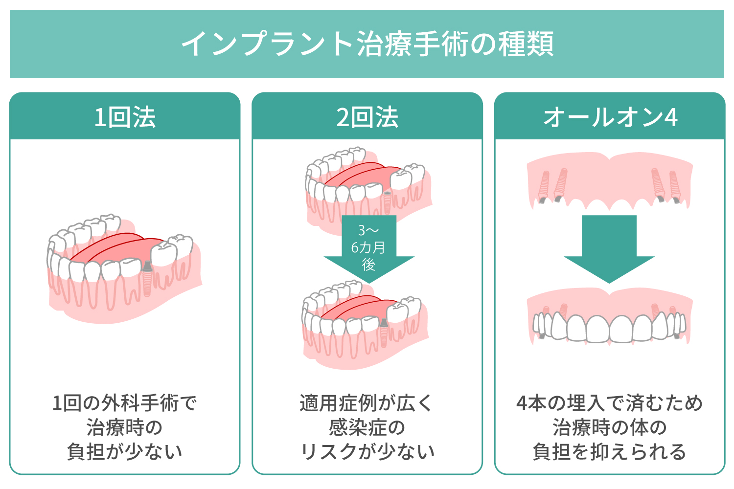 インプラント治療の手術の種類