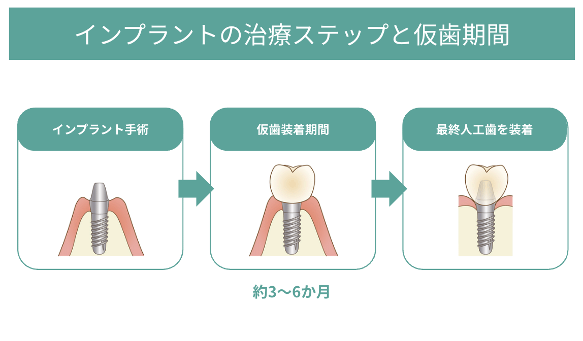 インプラントの治療ステップと仮歯期間