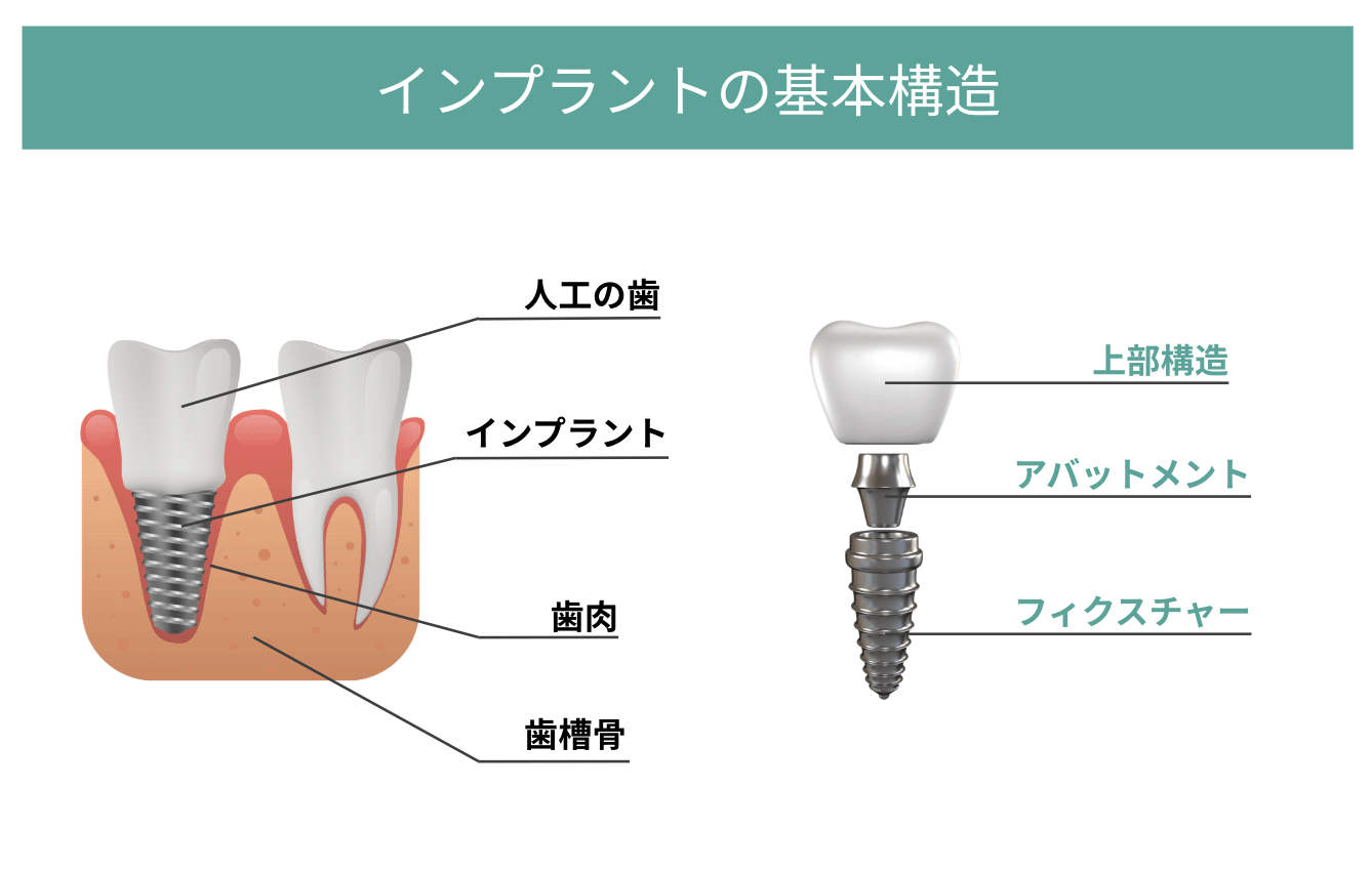 インプラント治療とセラミック人工歯の基礎知識