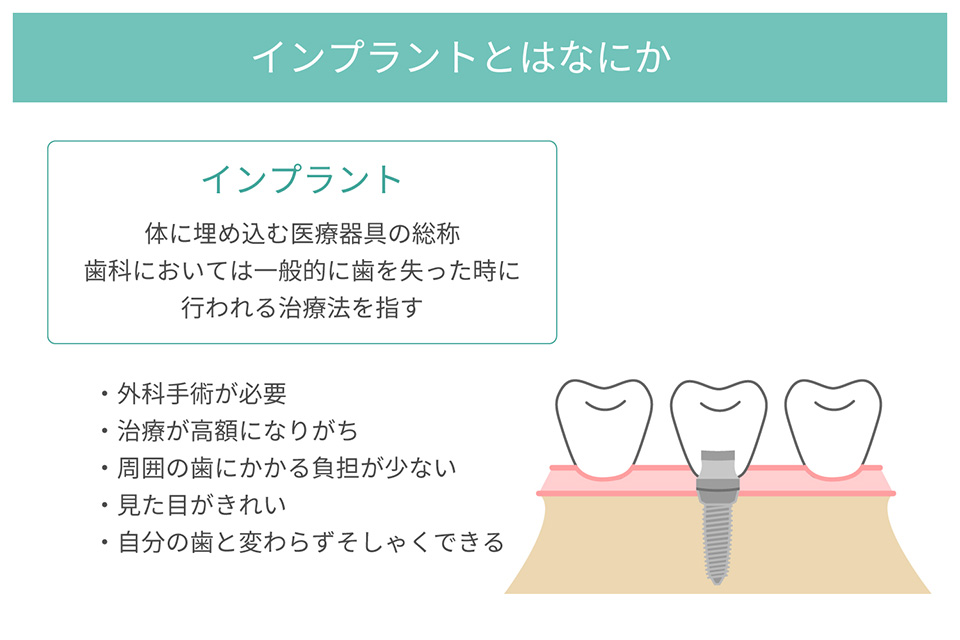 インプラントとは？