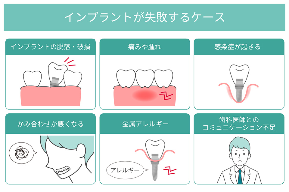 インプラントの主な失敗事例