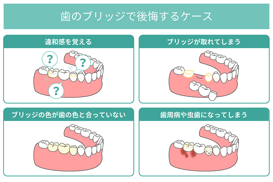 歯のブリッジで後悔する4つのケース
