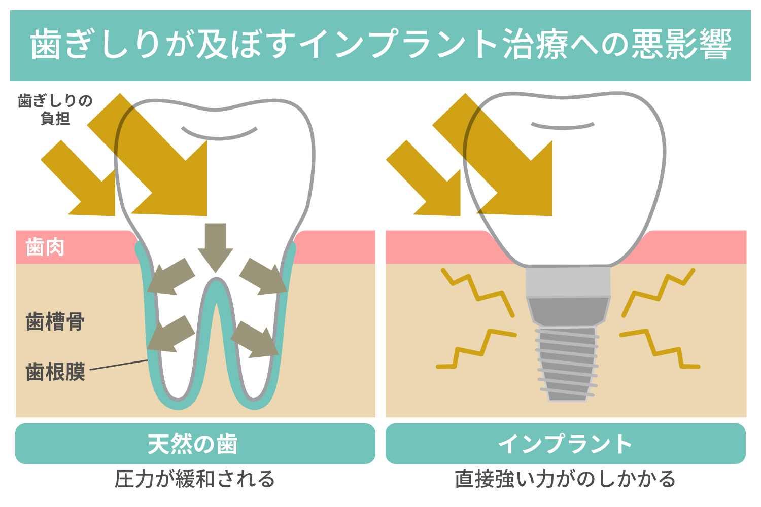 歯ぎしりがインプラント治療に良くない理由