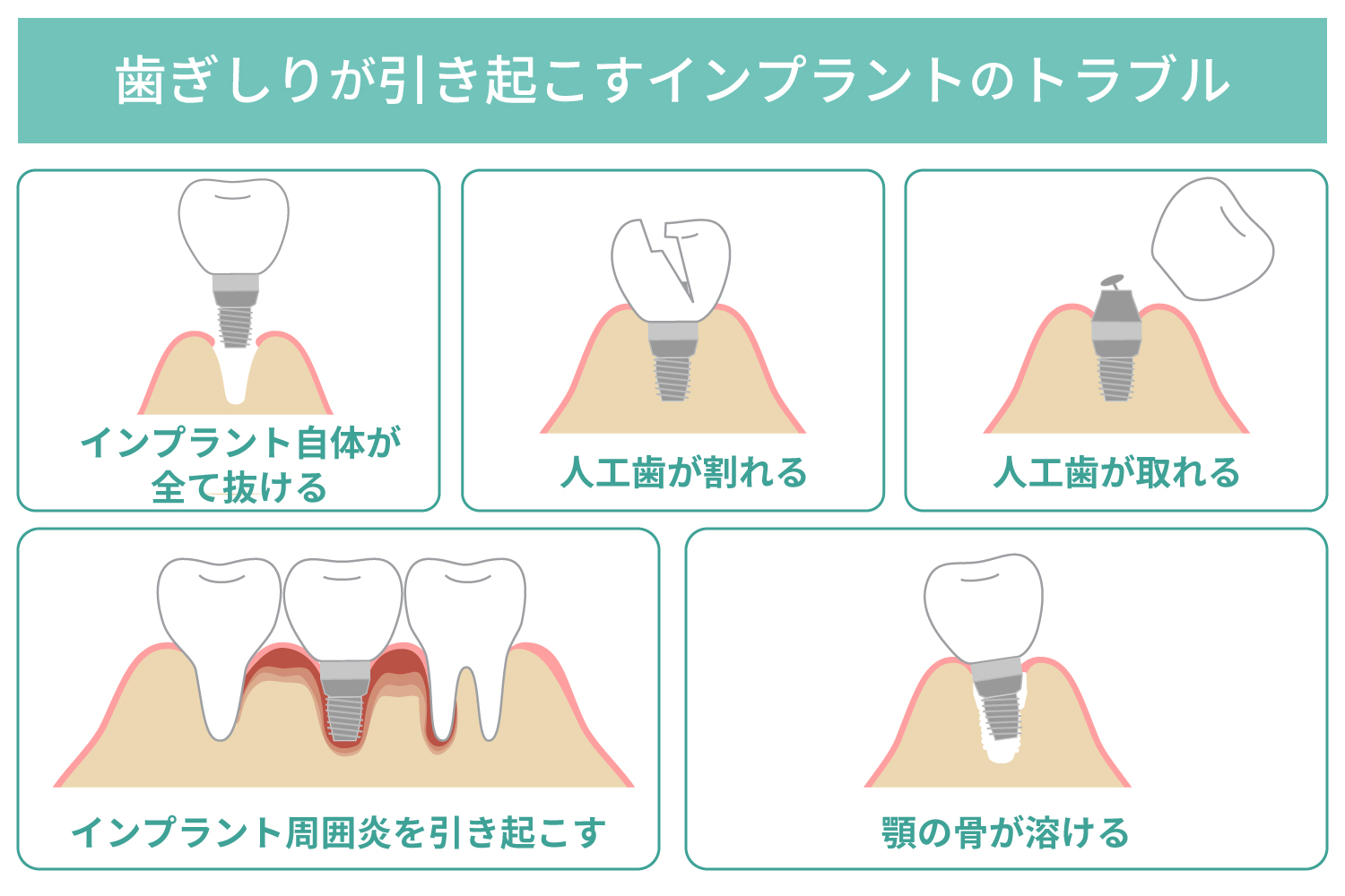 歯ぎしりが引き起こすインプラントのトラブル