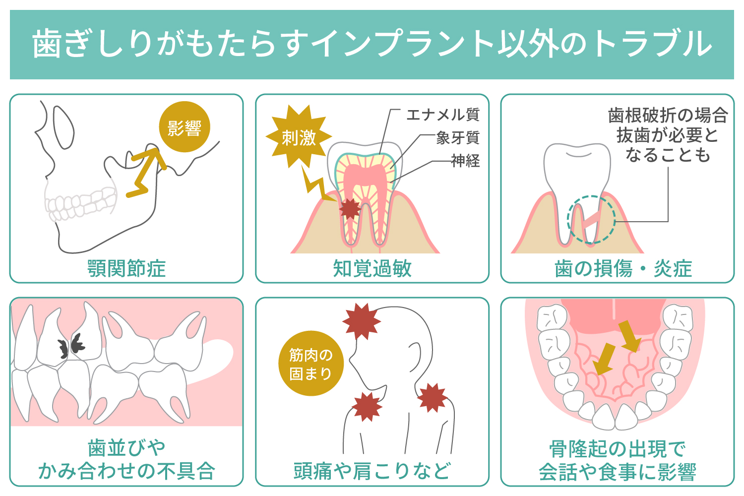 歯ぎしりがもたらすインプラント以外のトラブル