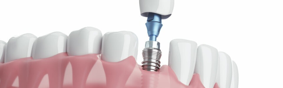 インプラントトラブルの対応策と予防策 Amazon.com: インプラントトラブルの対応策と予防策