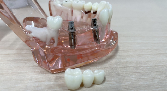 インプラントとブリッジ・入れ歯はどう違う？7つの観点から見る違い