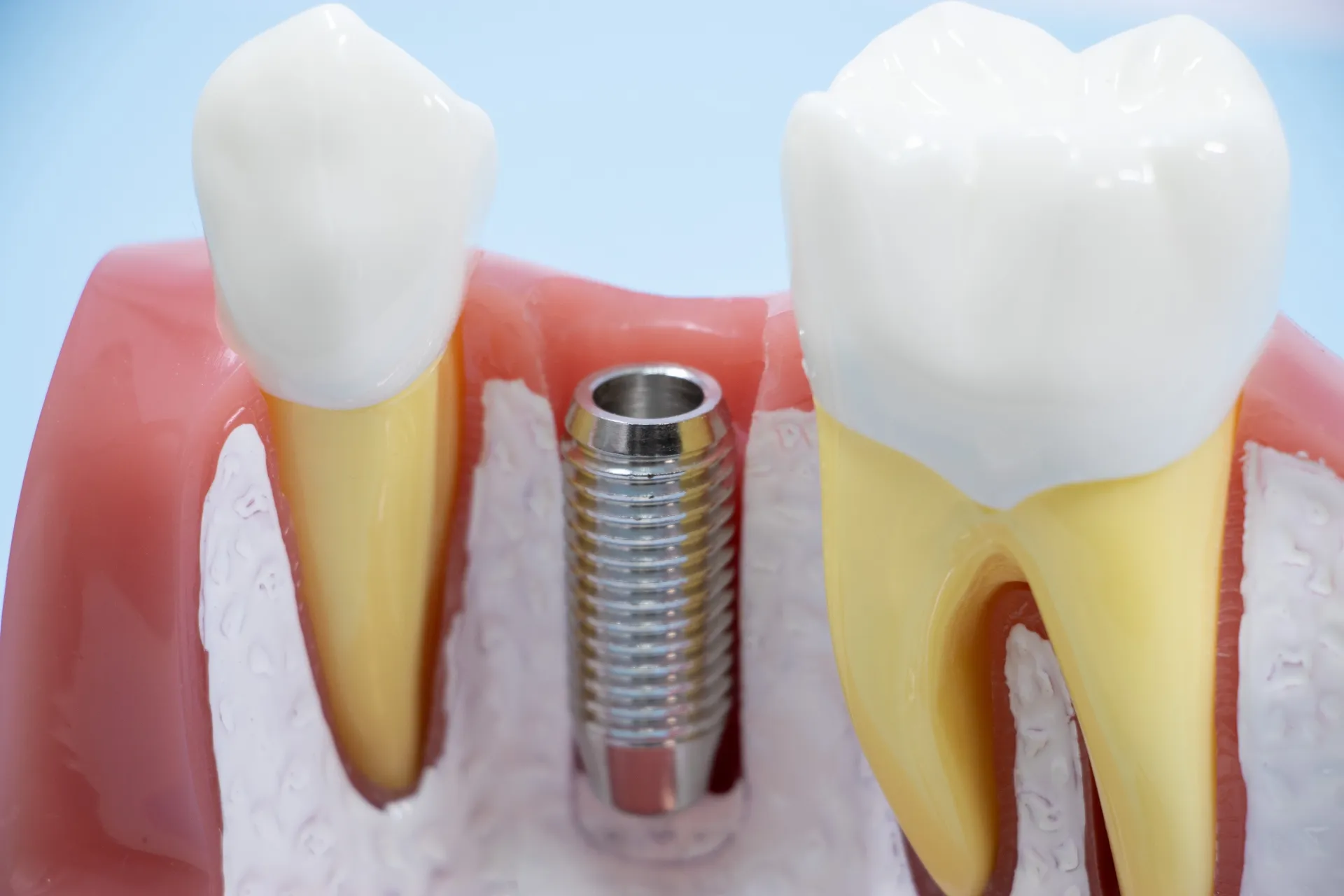 インプラント治療の歯がない期間はどの程度?対処方法も解説