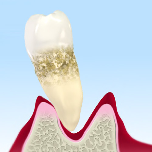 歯周病(重度)