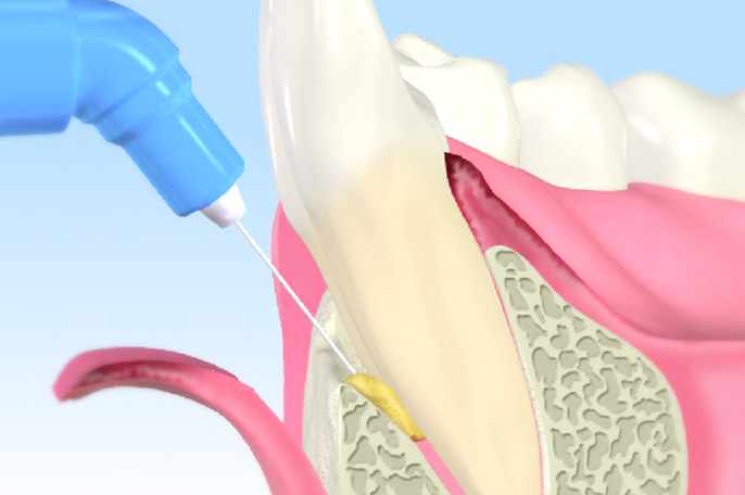 歯周病再生療法
